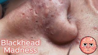 Massive Blackheads removal #42