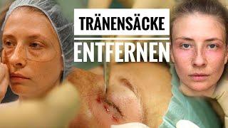 LIVE IM OP Blepharoplastik│Tränensäcke entfernen│Ella Ricarda