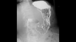 Radiographic Procedures: Esophagus, Stomach, and Small Intestine