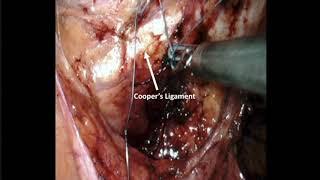 Robotic removal of Obturator Mesh and Burch Urethropexy