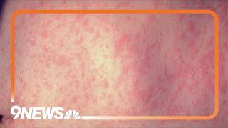 Colorado health officials: Check measles vaccine status ahead of spring break