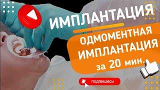 Одномоментная имплантация за 20 минут?