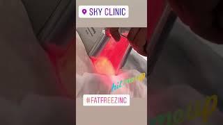 Fat Freezing Cryolypolisis at Sky Clinic Birmingham uk