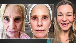 Cindy Spent $44k on Non-Surgical Treatments Before a Facelift: She Shares The Realities!