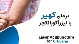 درمان کهیر 6 ساله  ----- Laser Acupuncture for Urticaria (Hive)