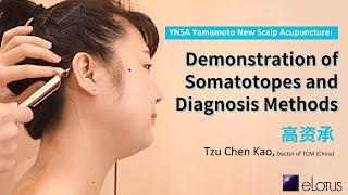 YNSA Yamamoto New Scalp Acupuncture: Demonstration of Somatotopes and Diagnosis Methods