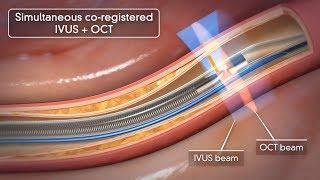 Novasight Hybrid System | Conavi Medical