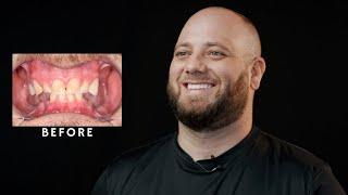 Teeth By Tonight Procedure! All On Four Dental Implants / Houston Dentist