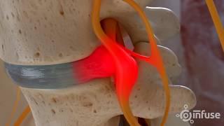 Discectomy Medical Animation - Infuse Medical
