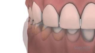 Gingivoplastie et gingivectomie  - Centres dentaires Lapointe