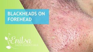 Blackheads on forehead