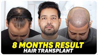 Best Hair Transplant in India | Best Results & Cost of Hair Transplant in India