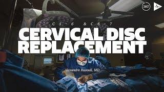 C 5-6 & C 6-7 Artificial Cervical Disc Replacement by Dr. Alexandre Rasouli | Case Trailer