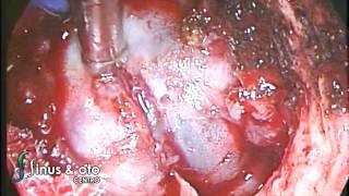 Large Midline Pituitary Tumor