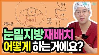 눈밑지방재배치 수술방법