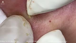 Big Cystic Acne Blackheads Extraction Blackheads & Milia, Whiteheads Removal Pimple Popping