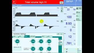 Optimizing Oxygenation on Mechanical Ventilation: Strategies for Improving MAP in Hypoxemic Patients