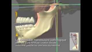 Presentation of CMTH (three-dimensional mandibular concept of Dr. Harb) by 3D animation