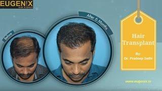 Eugenix Hair Transplant Reviews, Hair Transplant Before and After