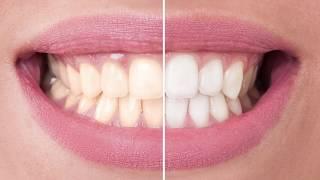 FAQ How can I whiten my teeth | Lakeshore Dental | Amrish Patel, DMD