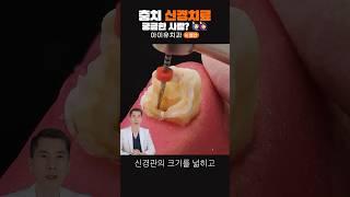 충치 신경치료 과정 #shorts