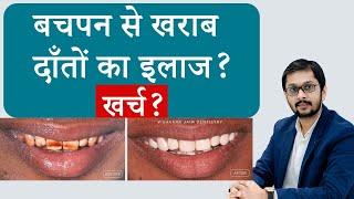 बचपन से खराब दांतों का इलाज ? खर्च ? | Dr Ankit Khasgiwala Seraphic Dental, Indore