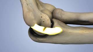 Kinduct - UCL "tommy john" 3D Animation