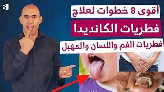 أقوى علاج للالتهابات الفطرية و الكانديدا | فطريات المهبل والامعاء واللسان _ كل ما تحتاجه في دقائق