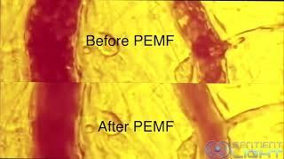 Blood Movements Images Before and After PEMF Treatments