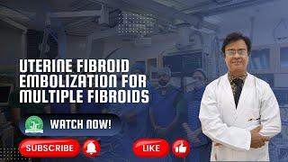 Uterine Fibroid Embolization for Multiple Fibroids | Dr. Sandeep Sharma | IRFACILITIES