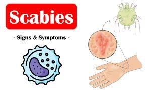 Scabies - Signs & Symptoms |What Are The Commonest Signs & Symptoms Of Scabies?