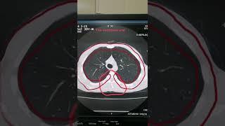Chest Scan with few ground glass changes | Axial view in Lungs window | Dr Green Side | Medical Imag
