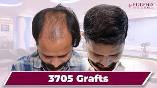 Best Hair Transplant Results in India | Hair Transplant in India