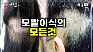 병원에서는 알려주지 않는 모발이식 수술 종류와 장단점