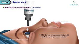 Corneal diseases  Corneal Dystrophies and Corneal Degeneration : Ophthalmology Lectures