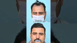 Repair Hair Transplant Before After Result | Corrective Hair Transplant in India