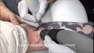 Laser Tattoo Removal, Skin Deep Laser Services, Burke VA, Northern VA, Fairfax County VA