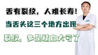 舌有裂纹，人难长寿！当舌头这三个地方出现裂纹，多是精血大亏了