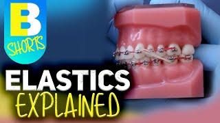 Braces Elastics Explained #shorts