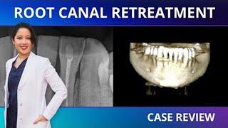 Case Bites | Analyzing a Root Canal Retreatment with CBCT