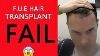 My Disaster FUE  Hair Transplant Failed! FARJO HAIR INSTITUTE.