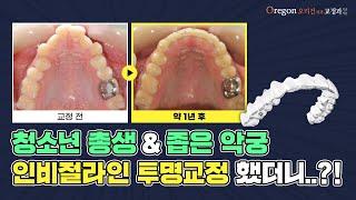 청소년 치아교정, 인비절라인 투명교정+오리건치과교정과만의 노하우로 교정한 결과!?!