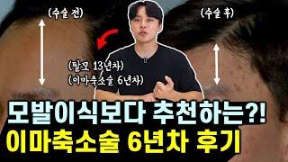 모발이식 vs 이마축소술 (효과, 부작용, 가격, 흉터, 장단점 비교, 100% 솔직 후기)