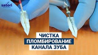 Чистка и пломбирование канала зуба