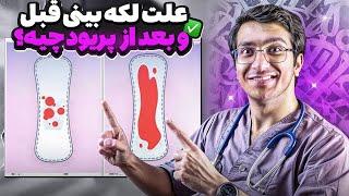 علت لکه بینی قبل  و بعد از پریود چیست؟