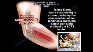 Tennis Elbow, Extensor Carpi Radialis Brevis, Everything You Need To Know - Dr. Nabil Ebraheim