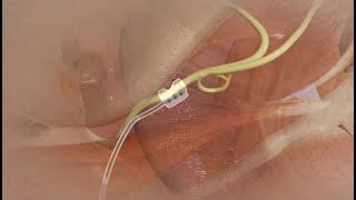 Hypoglossal Nerve Stimulator Device Implantation