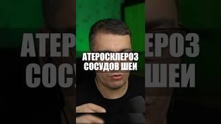 АТЕРОСКЛЕРОЗ АРТЕРИЙ ШЕИ #кардиолог #атеросклероз #статины