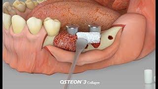 OSTEON™ 3 Collagen + 2017 Dentium world symposium in Barcelona thank you