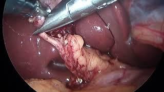 Colecistectomia laparoscópica/ Laparoscopic cholecystectomy